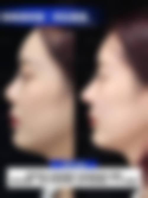 术后修复，成都青羊雅肤媛卢帆医生时刻关注