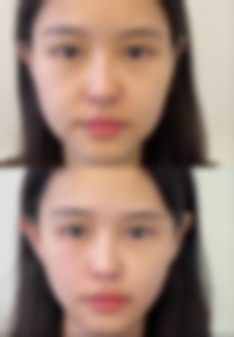 面部填充取出深度解析：揭秘手术流程、恢复效果与潜在风险，让你心中有数！