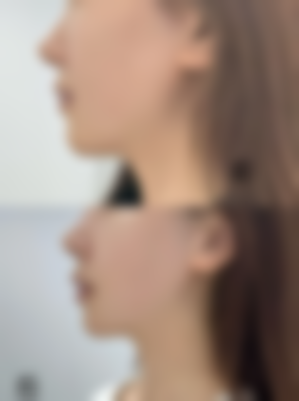 三、面部填充注射物取出医院推荐