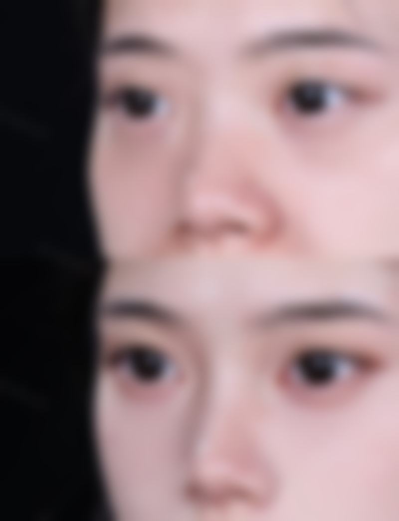 丰太阳穴有什么危险？了解这些潜在风险，掌握3大规避方法，让你安全拥有饱满太阳穴！ 