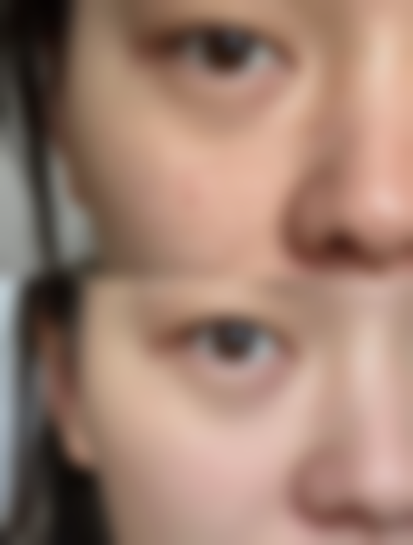 长期打瘦脸针会不会致癌