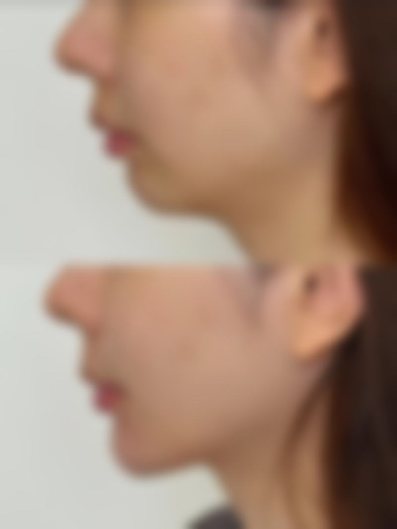 头发种植术后护理