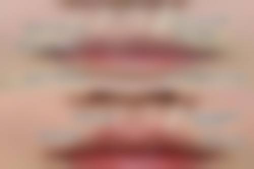 瘦脸针可以打出下颌线嘛