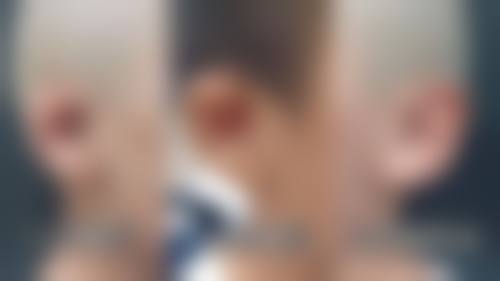 种植头发影响生育吗