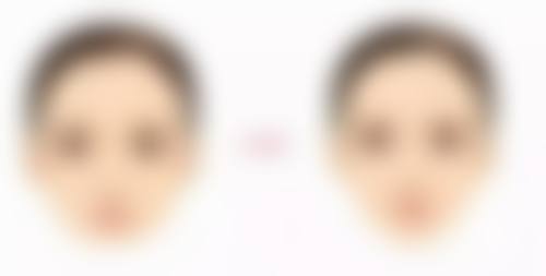 打完除皱针脸僵硬怎样能修复的快点