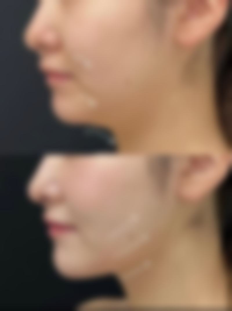 怎么让下嘴唇变厚一点