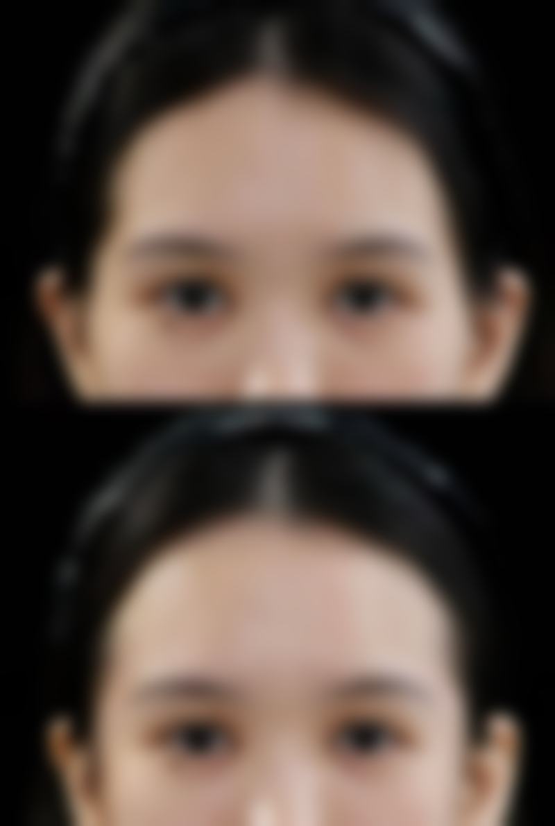 打瘦脸针对以后怀孕有影响吗