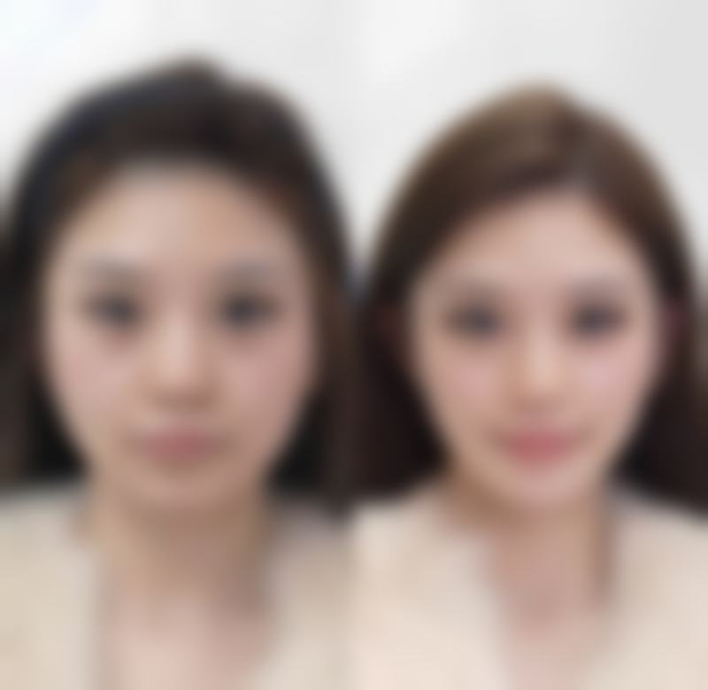 哪款玻尿酸填充太阳穴好