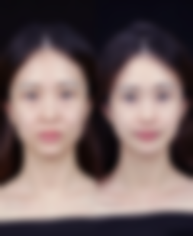 打瘦脸针加下颌缘提升多久起成效