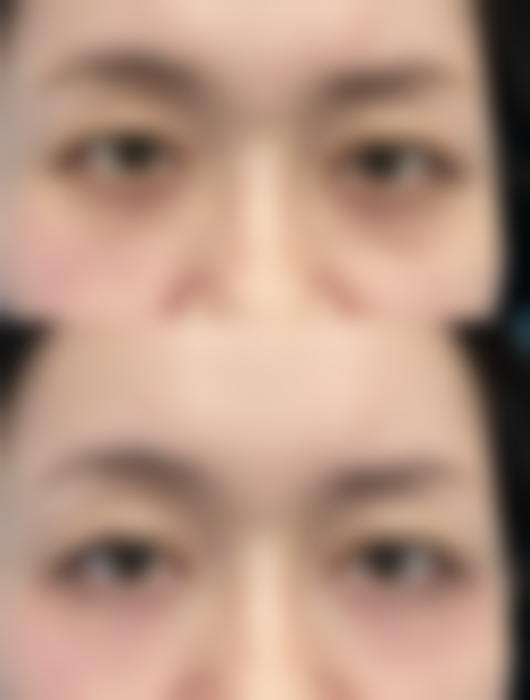 什么牌子的玻尿酸丰太阳穴好？揭秘5大热门品牌优势，助你轻松拥有饱满自然太阳穴！ 