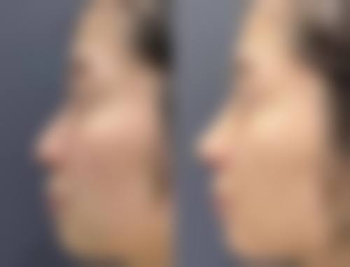 瘦脸针打几次就恒久了