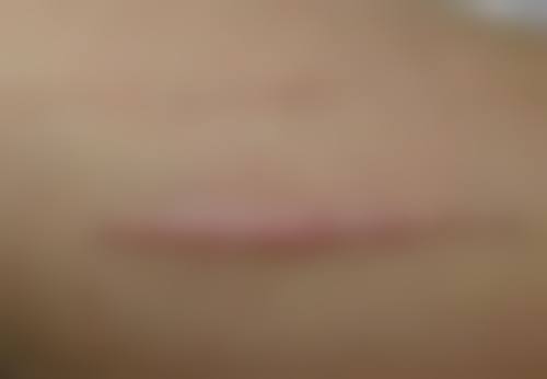 植发后要注意事项