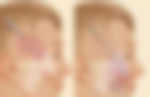 毛发种植有害吗