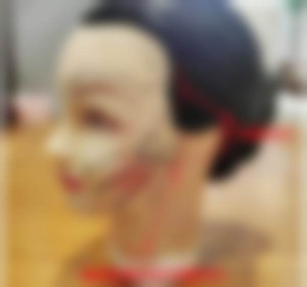 65岁老人在北京黄寺医疗美容门诊部做拉皮手术，术后年轻十岁有余，这效果直接惊艳到我了！ 