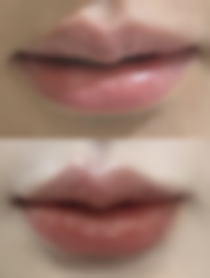 下颌缘瘦脸针有副作用吗？医生揭秘：正规操作下95%低风险，效果显著值得一试！ 