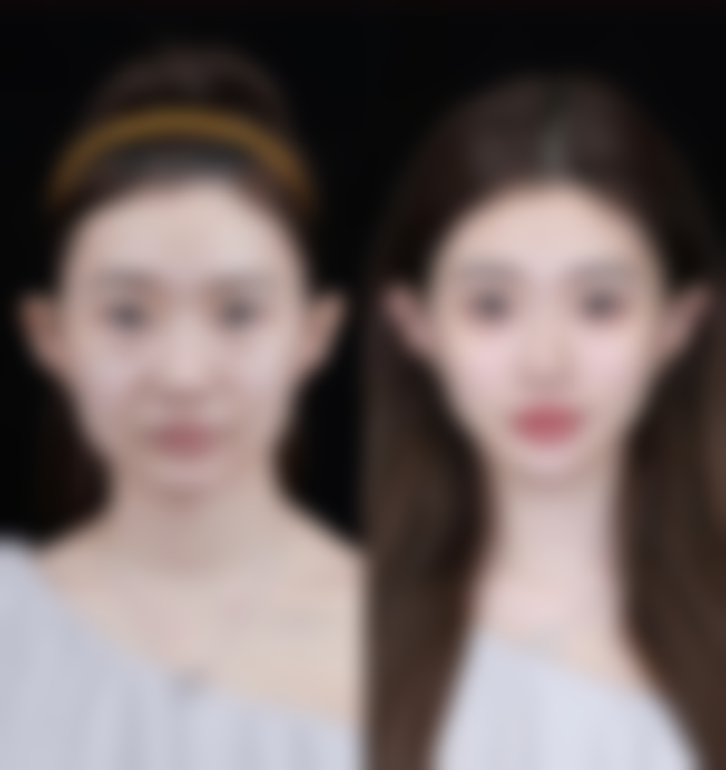 下颌缘加瘦脸针