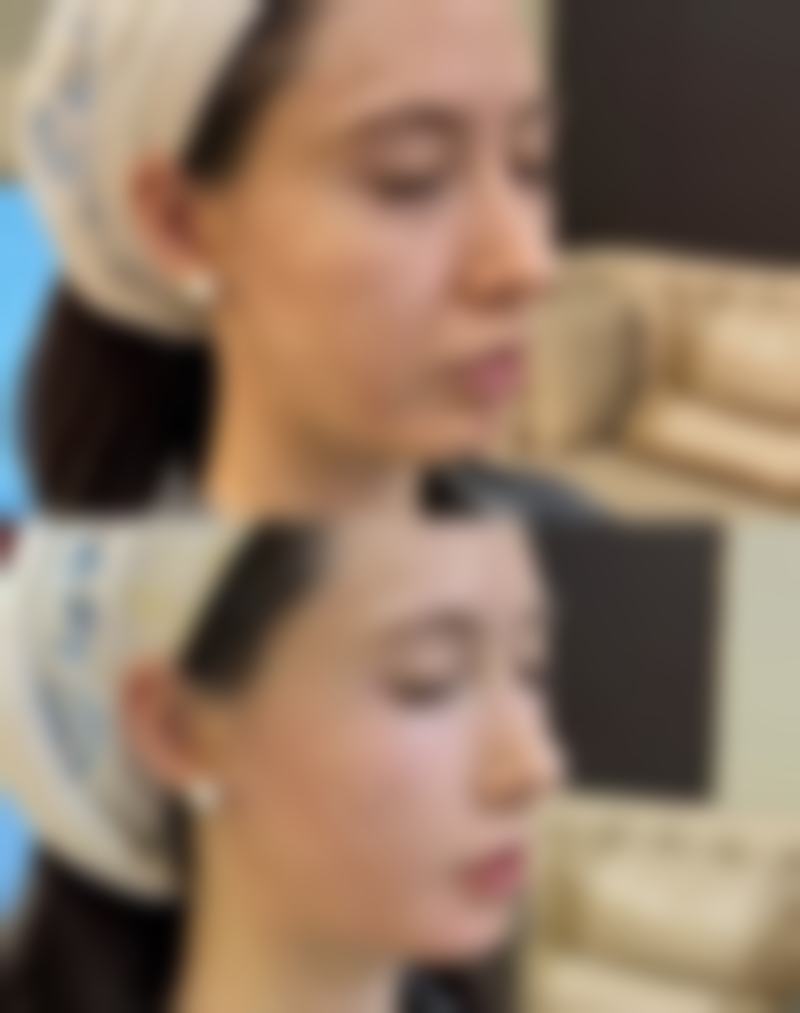 拉皮除皱成效怎么样好不好?