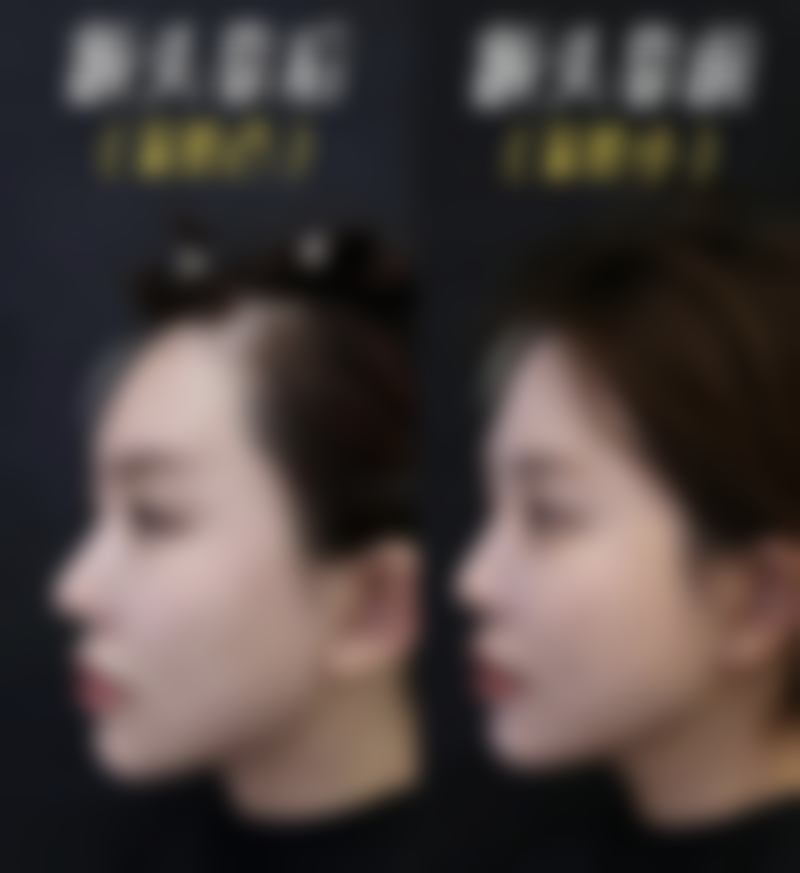 儿童龋齿的成因危害与预防措施