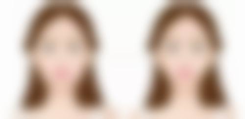 打瘦脸针后五官都变了