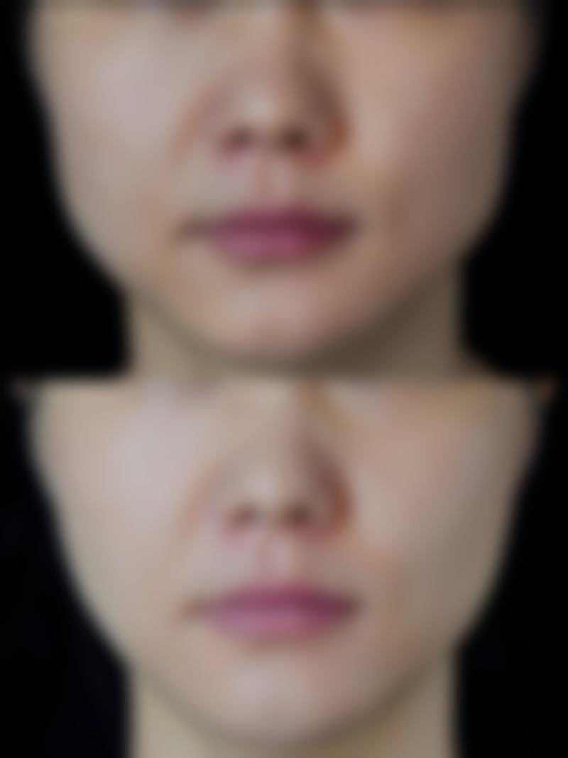 注射瘦脸针管用吗