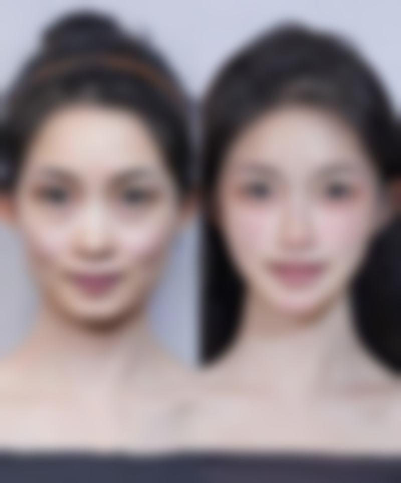 瘦脸针去哪里打