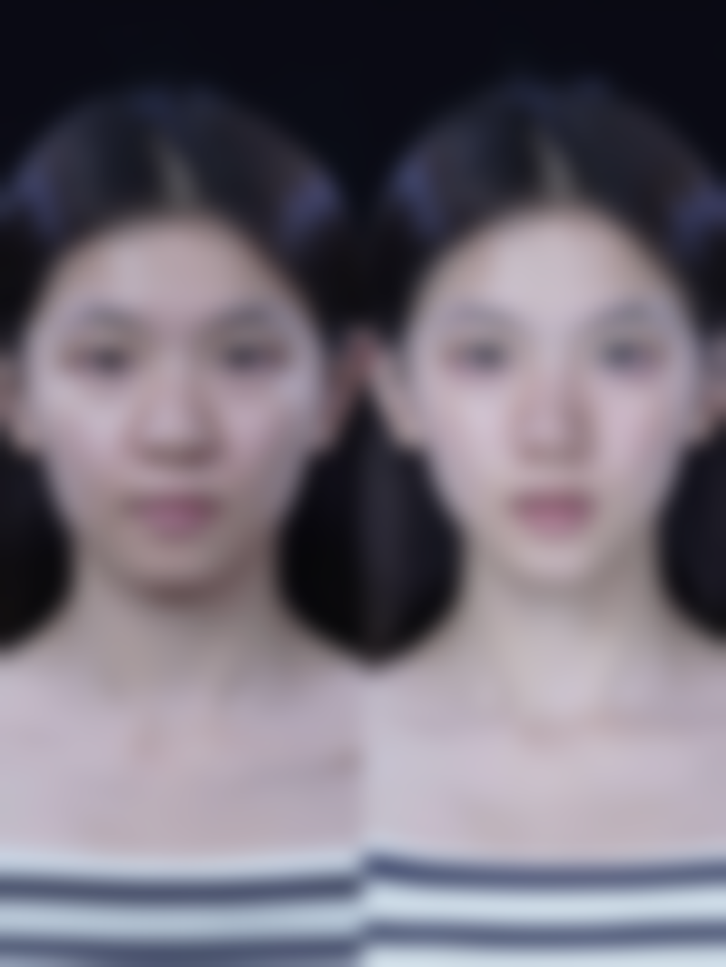 瘦脸针打完多久见效