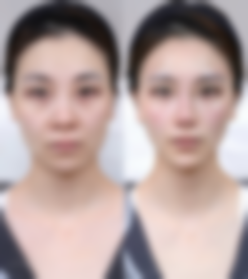 打瘦脸针脸歪了还能修复吗