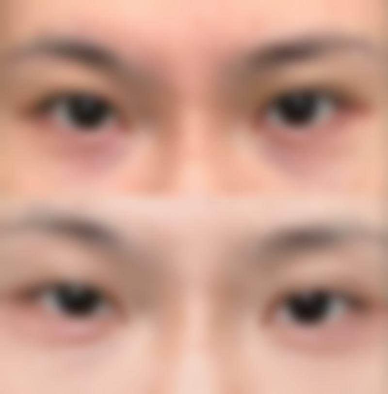 瘦脸针多久打一次成效至佳