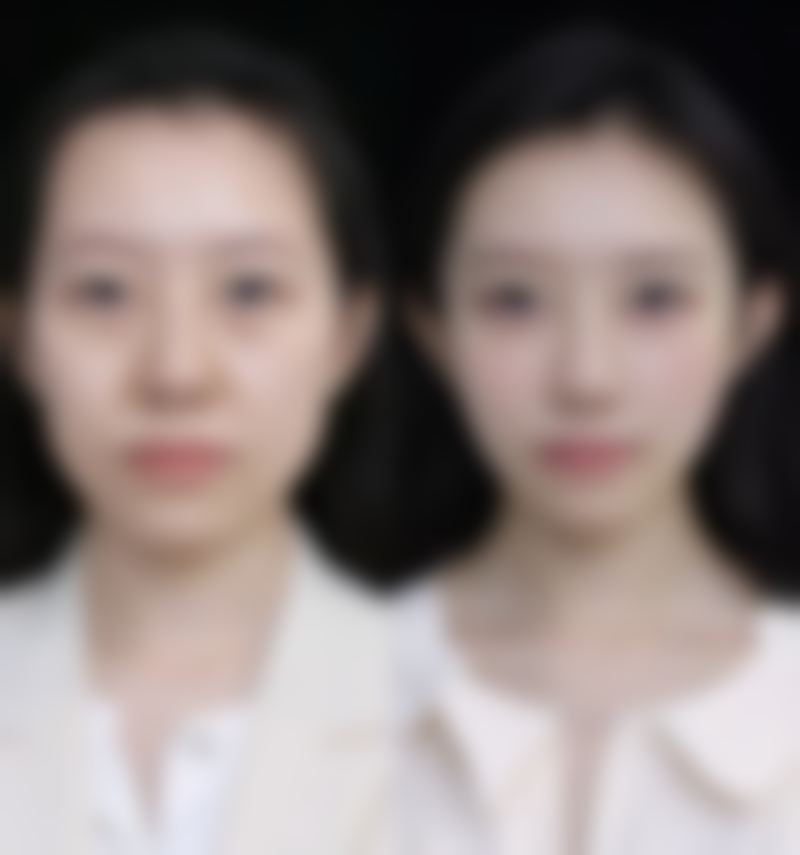 注射瘦脸针有哪些？细数3种热门医美方式，效果显著、安全无忧，让你轻松拥有精致小脸！ 