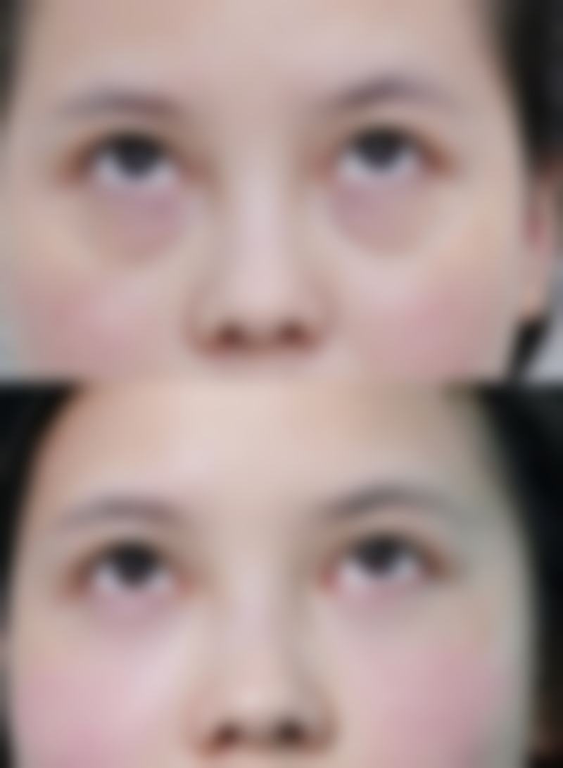 瘦脸针多少钱一次，要打几次定型