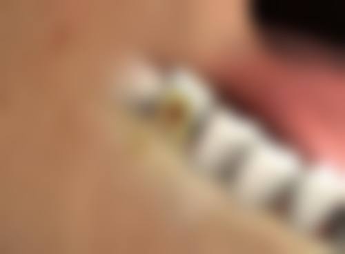 美容院的除皱针打了对身体有害吗