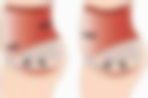 打 Botox 除皱有哪些副作用