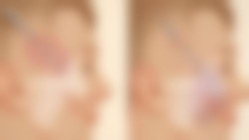 Botox 注射除皱术