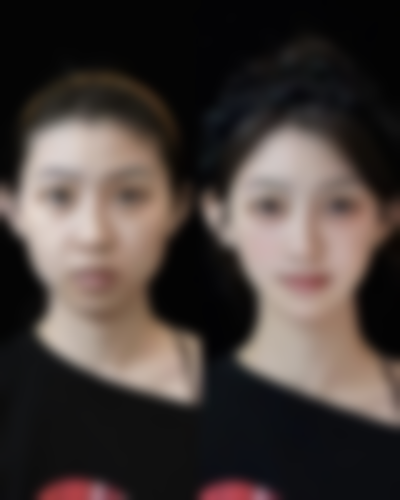 毛发种植技术好吗