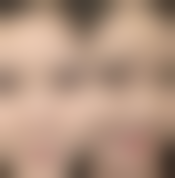 注射 Botox 除皱针有什么要注意的吗