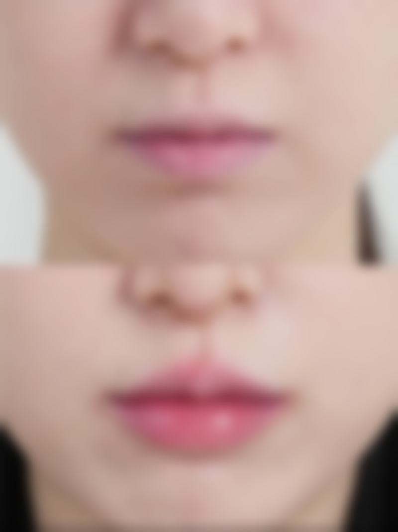 打了瘦脸针后注意什么饮食