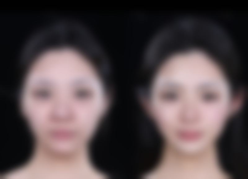 Botox 除皱保持多久