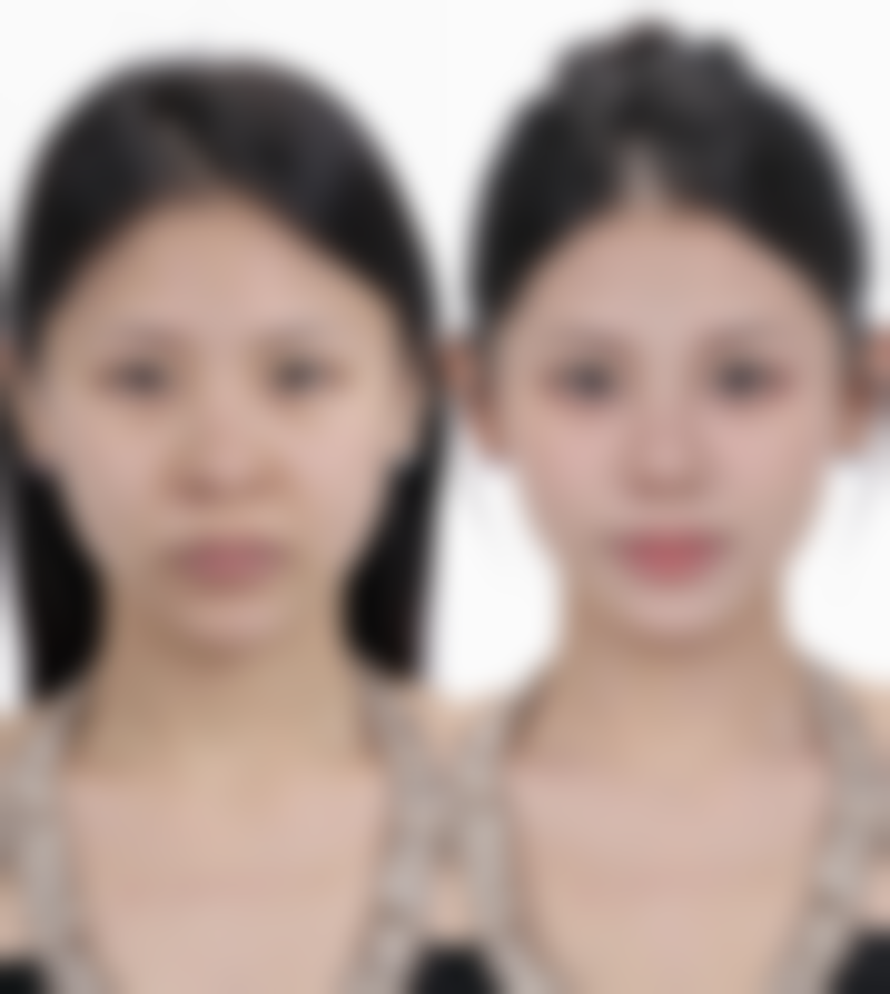 打美容除皱针除皱纹的针有副作用吗