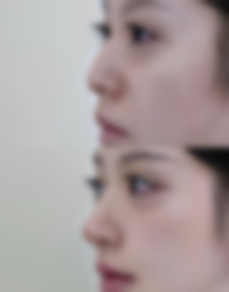 打美容除皱针除皱纹的针有副作用吗？专业揭秘4大常见疑问，告诉你安全变美秘籍！ 