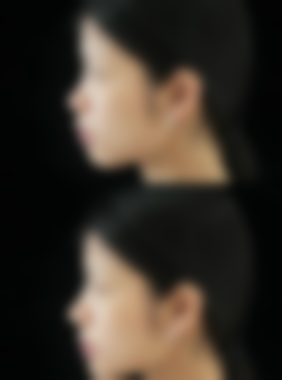 毛发种植能维持多少年