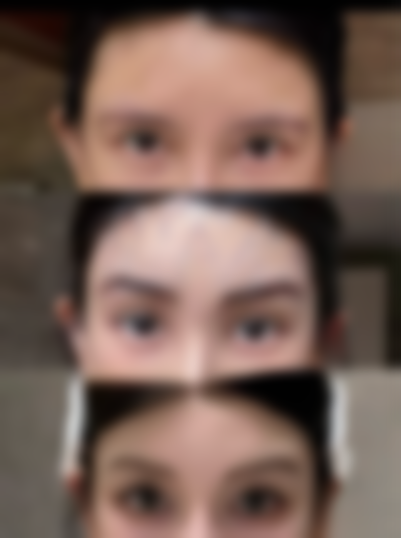 瘦脸针可以下颌缘紧致嘛