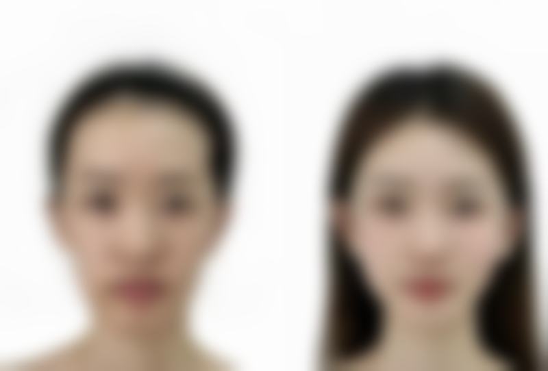 打了瘦脸针2个小时后平躺了会怎样