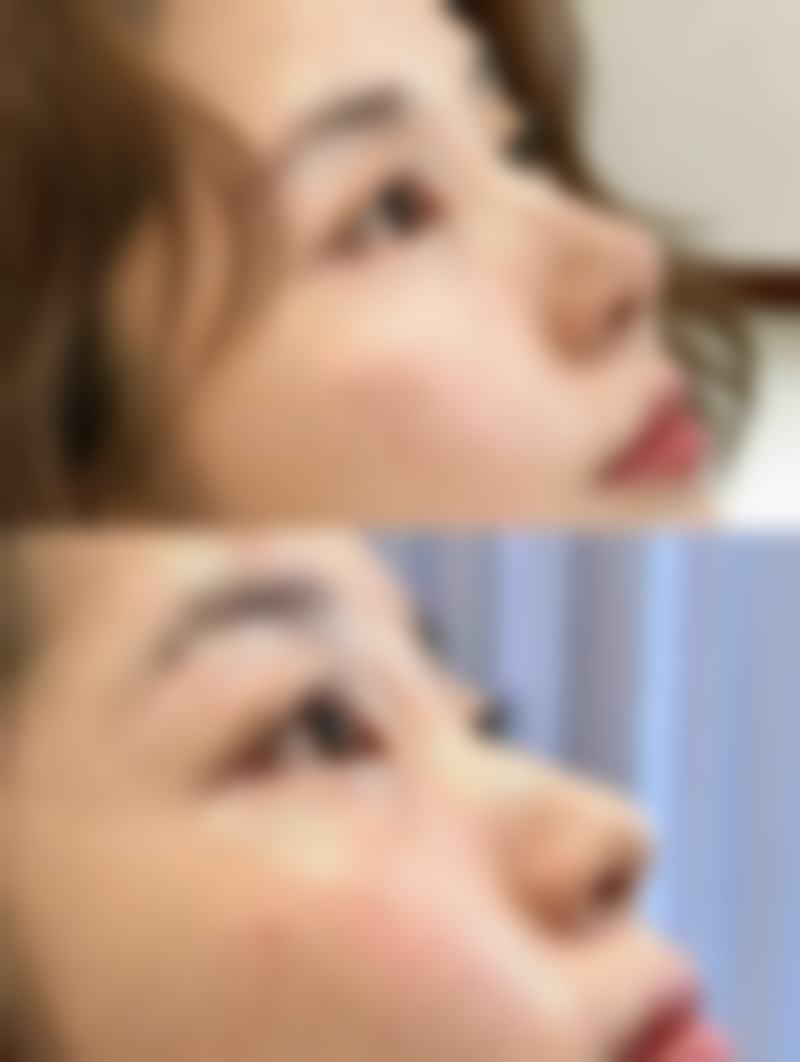 打瘦脸针对下颚线有用吗