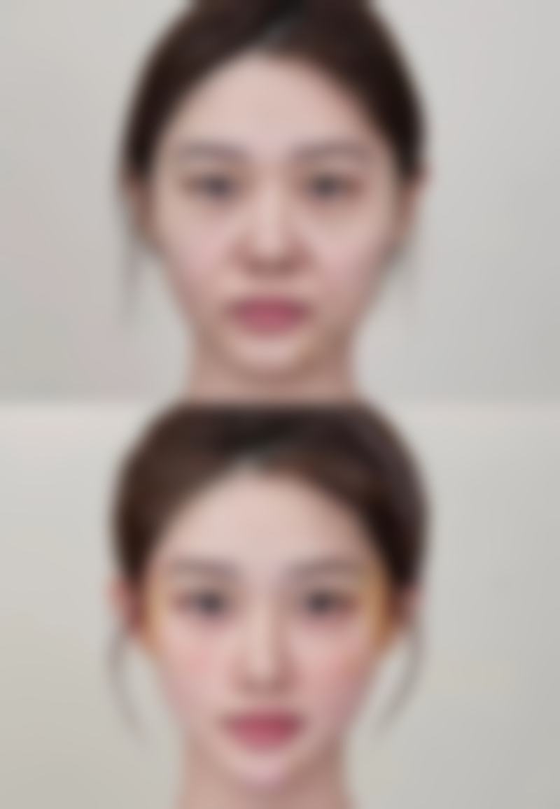 打完除皱几天有成效