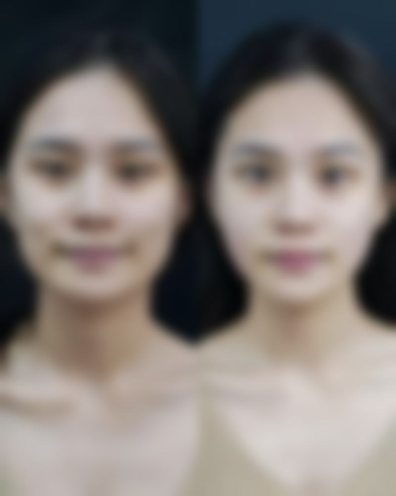 自体血清注射除皱的修复时间