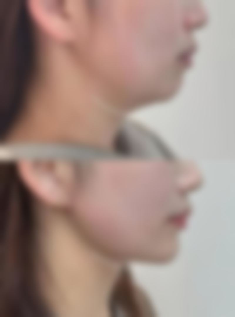 打完除皱针面部僵硬多久可以修复