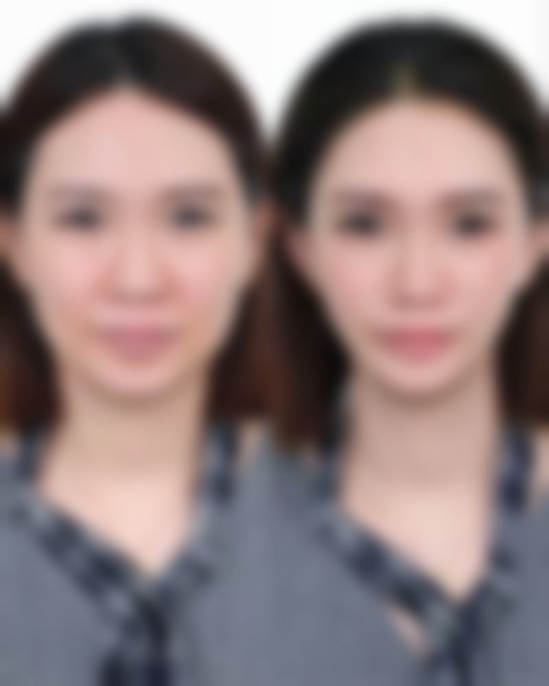 阴道紧缩术的修复和注意事项