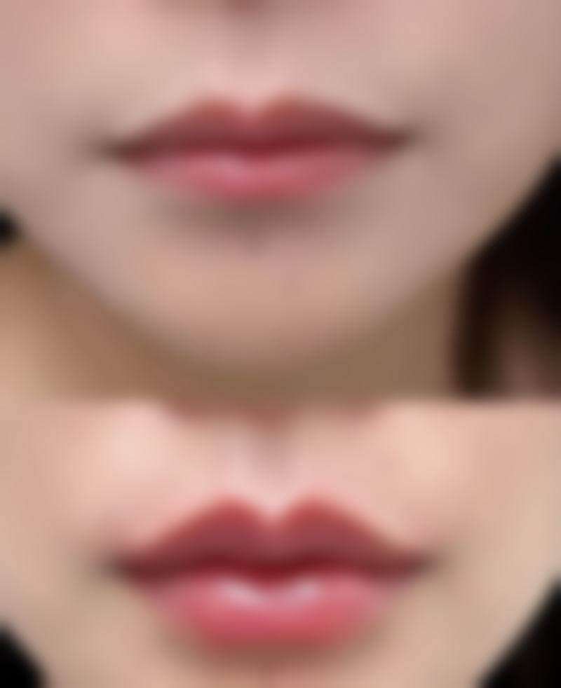 瘦脸针去哪里打