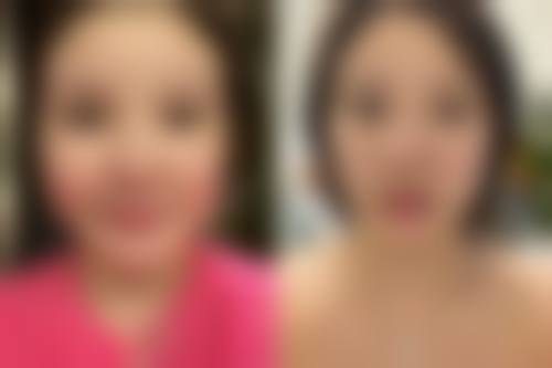 丰太阳穴打玻尿酸的价格及所需支数