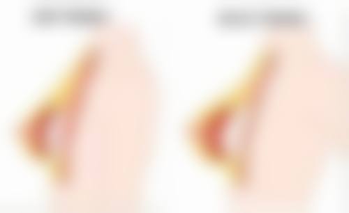 面部拉皮大概需要多少钱